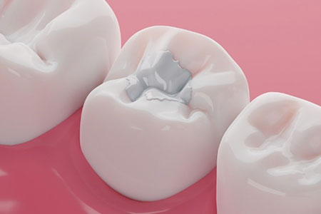 Tooth-Colored Fillings: Cavity Filling with Aesthetic Appeal